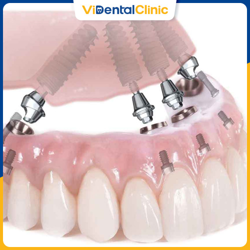 Cấy ghép Implant giúp phục hồi răng hoàn hảo