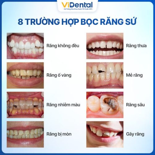 Hình ảnh chăm sóc răng sứ sau khi uống cà phê