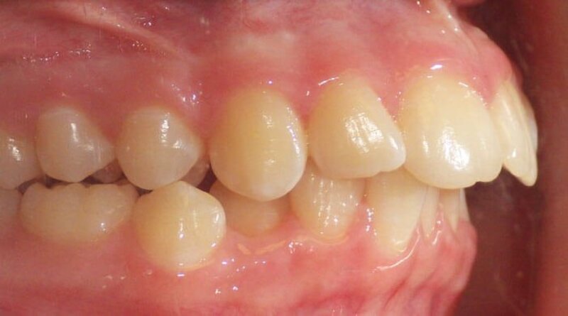 Hô nướu là tình trạng răng hô do phần xương hàm dưới nướu nhô ra quá nhiều