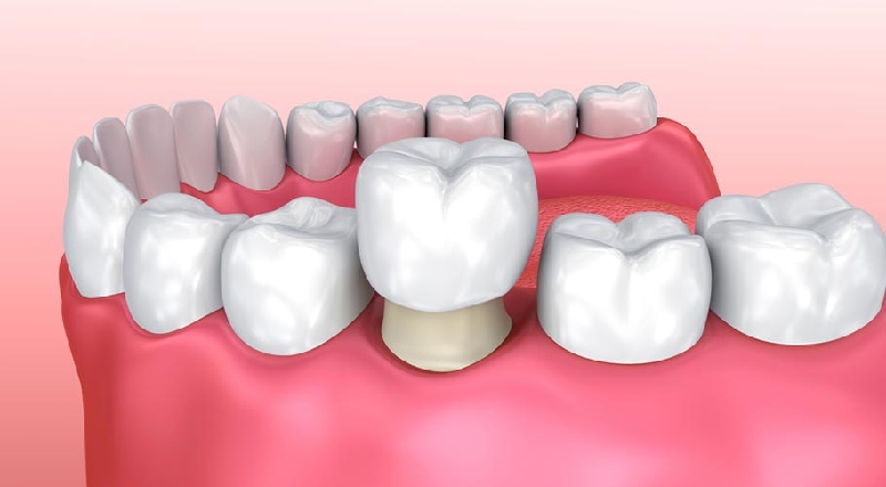 Bọc răng hàm thường được chỉ định trong một số trường hợp