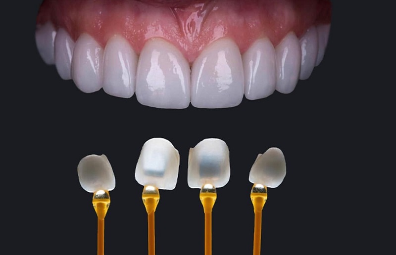 Phương pháp dán sứ chỉ dành cho những hàm răng ít khuyết điểm