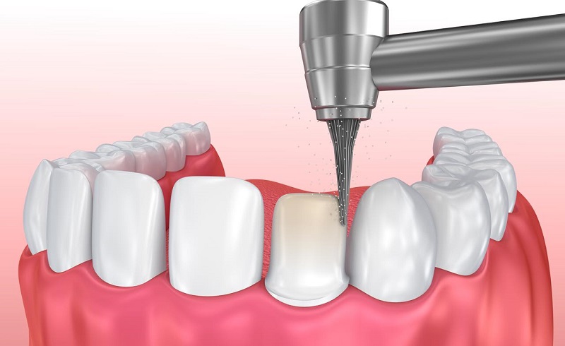 Bọc răng sứ không cần mài răng chỉ được áp dụng trong một vài trường hợp nhất định