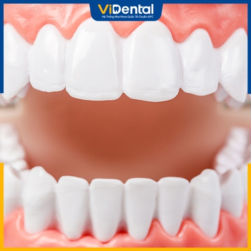 Bọc răng sứ giống răng thỏ giúp tăng tính thẩm mỹ