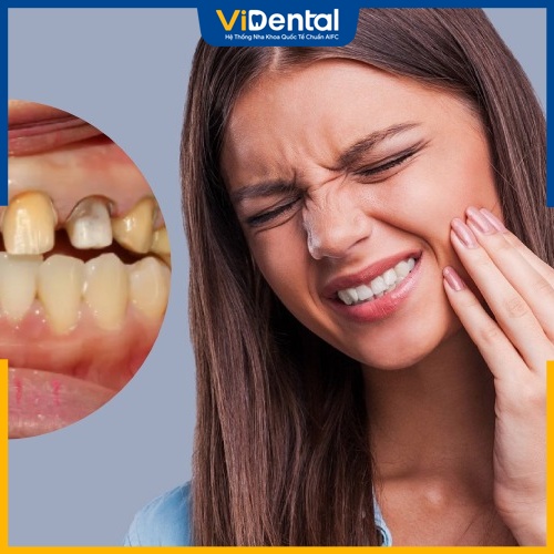 Răng sứ bị xuống cấp nghiêm trọng cần điều trị nha khoa 