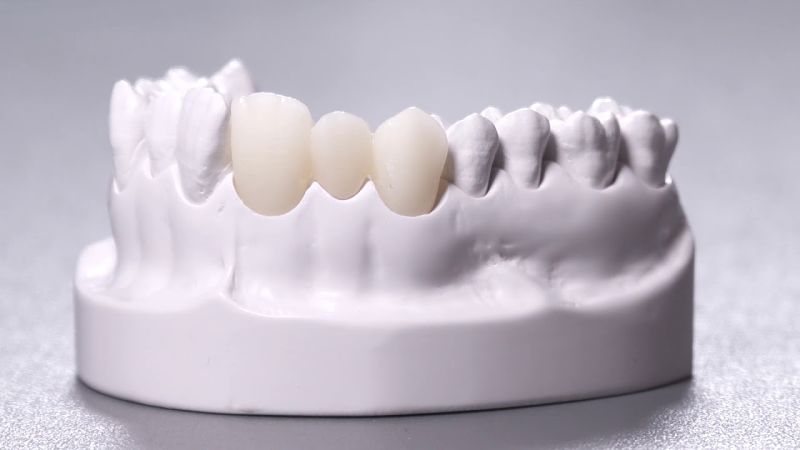 Có nhiều chất liệu răng sứ mà bạn có thể lựa chọn hiện nay