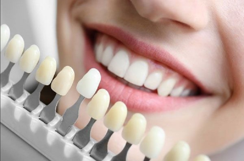 Bọc răng sứ titan được đánh giá là thích hợp cho tất cả các trường hợp