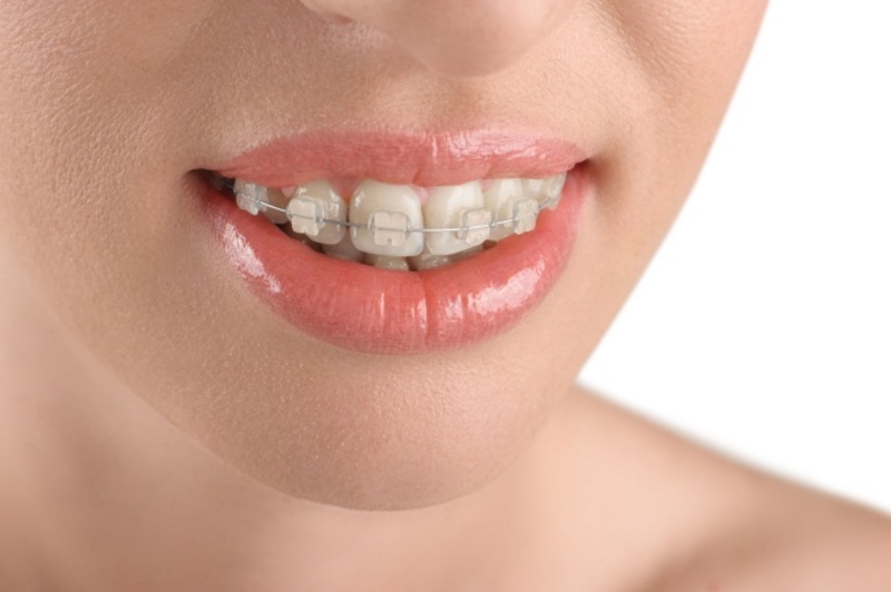 Phẫu thuật răng hô giúp cải thiện tình trạng răng miệng