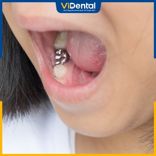 Chụp thép nhằm đảm bảo răng miệng phát triển khỏe mạnh
