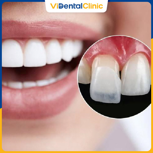 Dán răng sứ nguyên hàm dao động từ 50.000.000 - 300.000.000 VNĐ