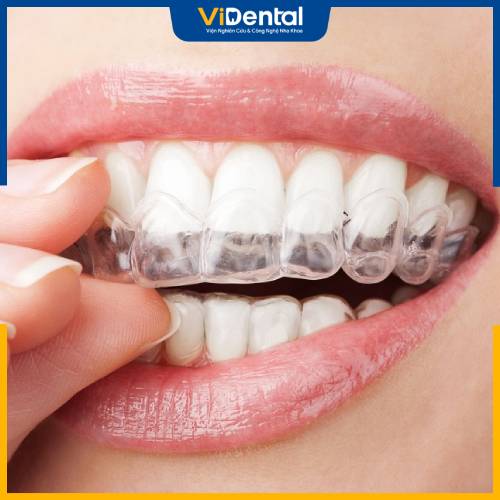 Đeo hàm duy trì được chứng minh có thể giúp chỉnh lệch mặt sau khi niềng răng 