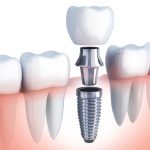 implant-han-quoc-hinh-anh-1
