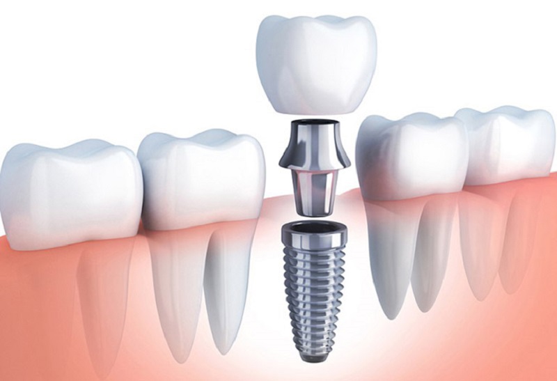 Trồng răng với trụ Implant Hàn Quốc có nhiều lựa chọn khác nhau 