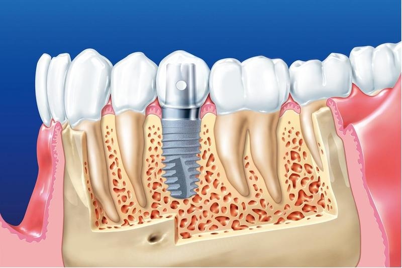 Mỗi phòng khám lại có bảng giá trồng răng implant Hàn Quốc khác nhau
