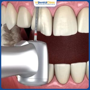 Mài răng bọc sứ là thao tác bắt buộc thực hiện trước khi bọc răng sứ