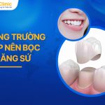 Những Trường Hợp Nên Bọc Răng Sứ Cần Lưu Ý