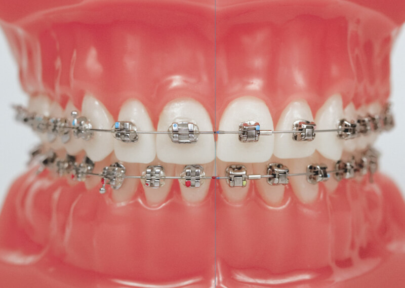 Tùy vào tình trạng răng miệng bác sĩ sẽ khuyên bạn có nên nhổ răng khi niềng răng hay không
