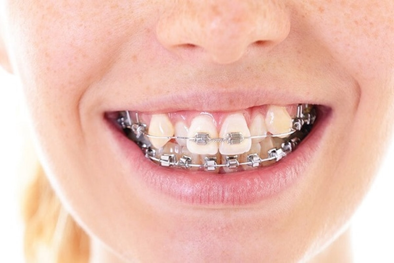 Niềng răng có mất răng khểnh không là câu hỏi của rất nhiều người khi thực hiện niềng răng?