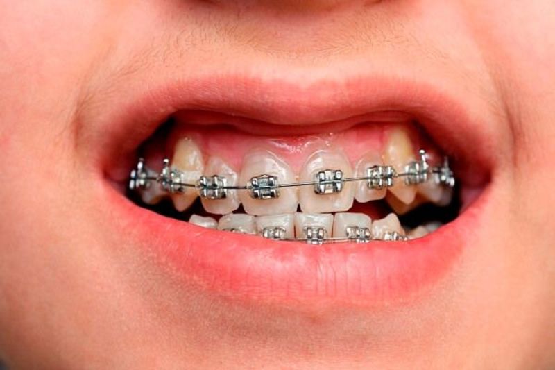 Có rất nhiều nguyên nhân dẫn đến tình trạng niềng răng hô xong bị móm