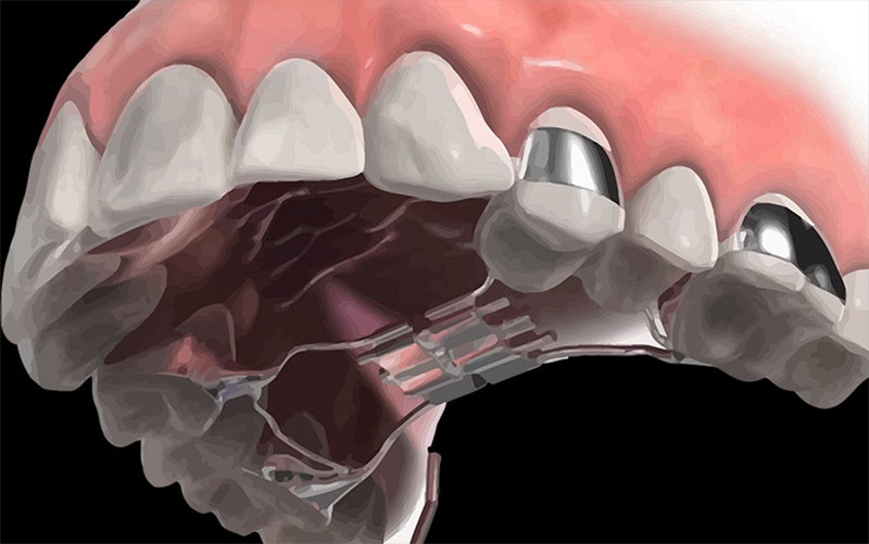 Có nhiều giải pháp để khắc phục không cần nhổ răng khi niềng răng