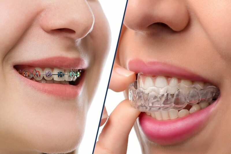 Niềng răng nhổ răng số 3 sẽ được áp dụng ở một số trường hợp