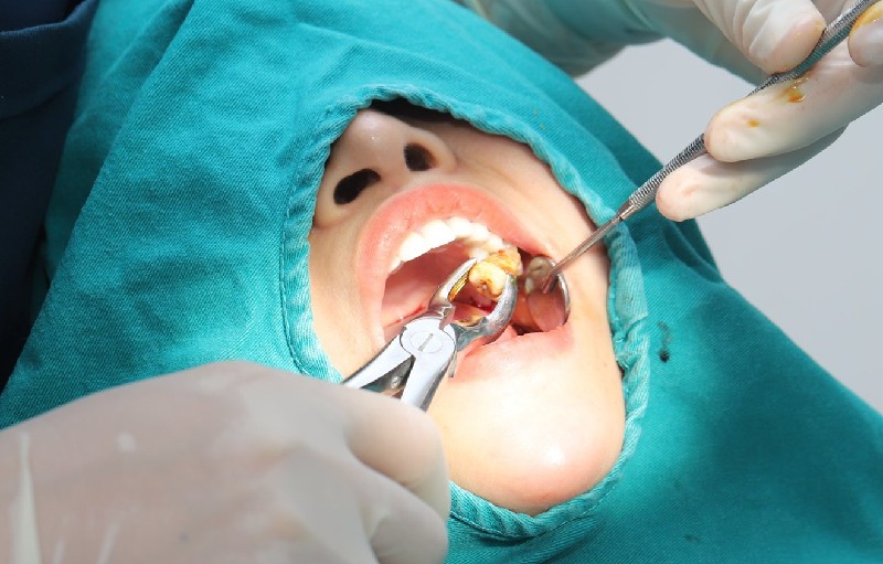 Nhổ răng số 6 khi niềng răng có nên hay không?