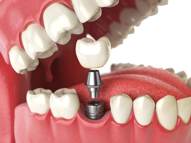 Trồng răng Implant cho răng số 6 trước khi niềng răng
