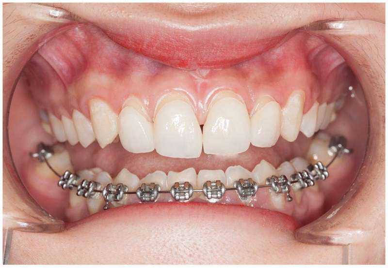 Nhổ răng số 8 không gây đau đớn