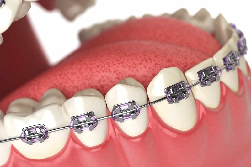 Mục đích niềng răng nhổ răng số 8 để hiệu quả chỉnh nha được tốt nhất