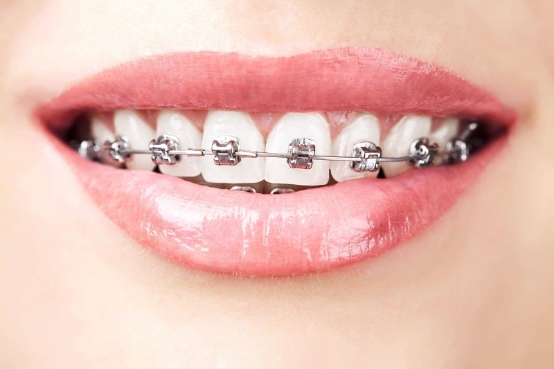 Niềng răng bằng mắc cài kim loại là phương pháp truyền thống