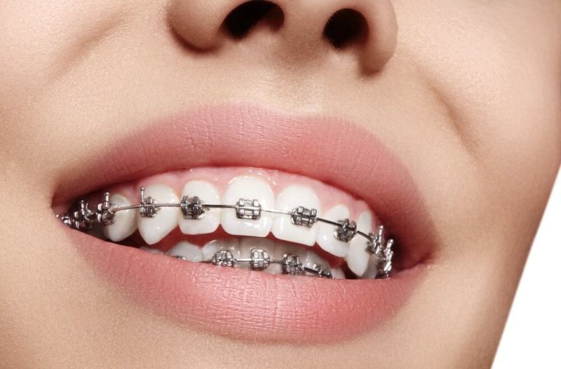 Chi phí niềng răng bằng sắt là thấp nhất trong tất cả các phương pháp