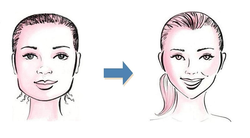 Niềng răng giúp thay đổi khuôn mặt tạo cằm V-line