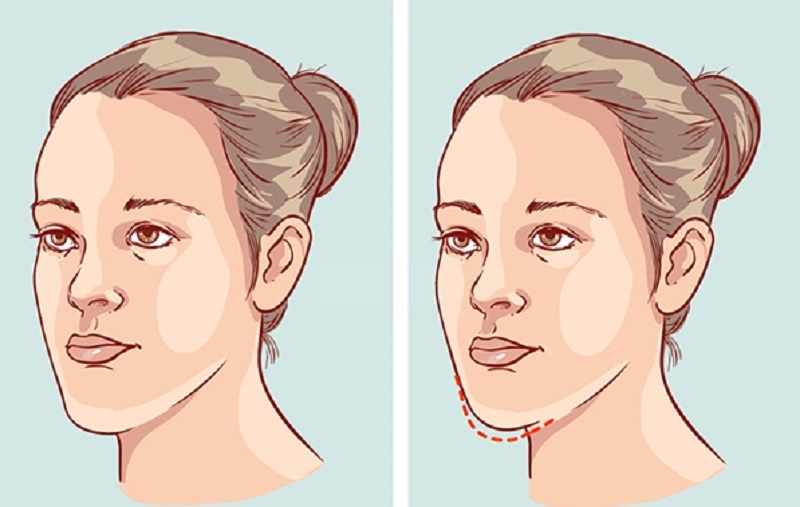Niềng răng thay đổi khuôn mặt chính là phương pháp được ưa chuộng