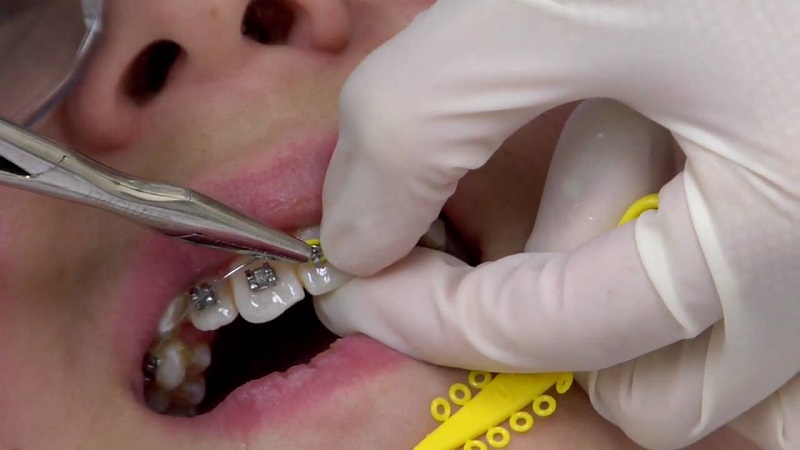 Niềng răng móm là phương pháp phổ biến và đòi hỏi thời gian kéo dài