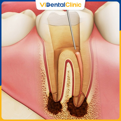 Răng bị mài mòn dẫn tới viêm tủy, mất răng