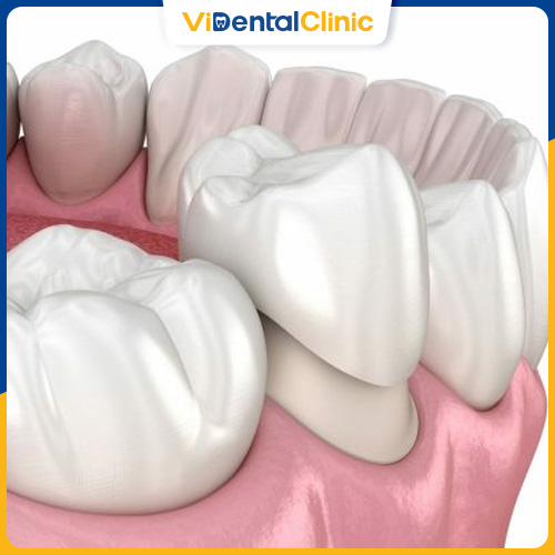 Bọc răng sứ phù hợp với tình trạng răng bị mòn ở mức độ nặng