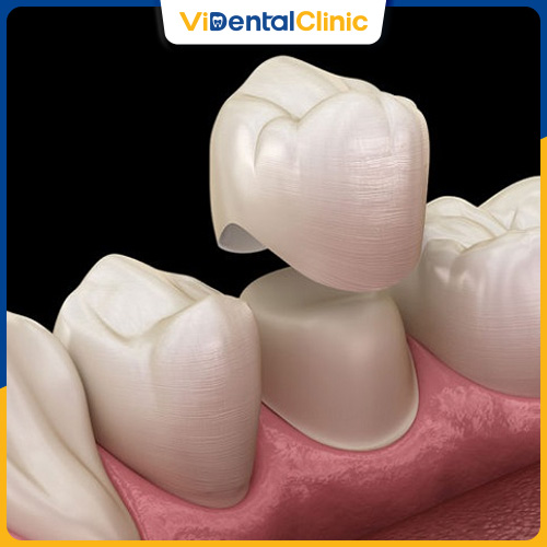 Bọc răng sứ giúp khắc phục nhanh chóng tình trạng mòn răng
