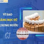 Vì Sao Răng Bọc Sứ Bị Sưng Nướu