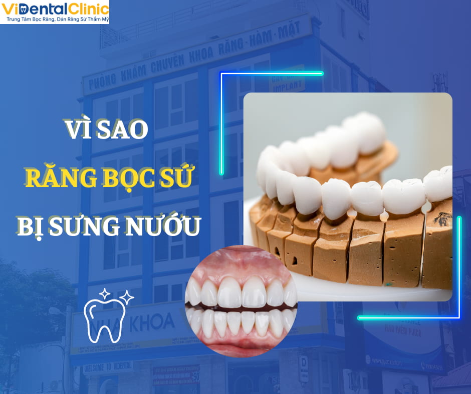 Răng sứ không chất lượng gây ê buốt