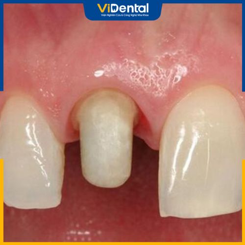 Bọc răng không đúng kỹ thuật dẫn đến tình trạng nhiễm trùng