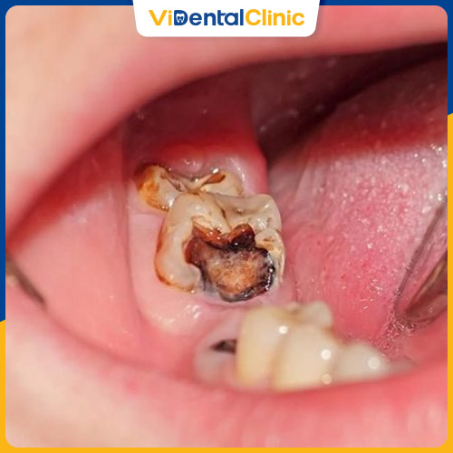Răng cấm bị sâu nặng cần xử lý sớm để tránh biến chứng