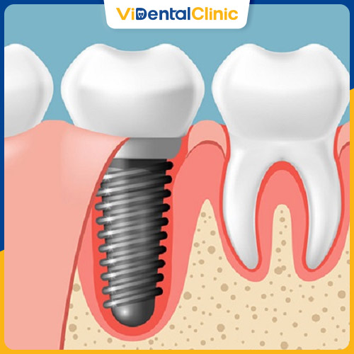 Trồng răng Implant giúp phục hình răng hiệu quả