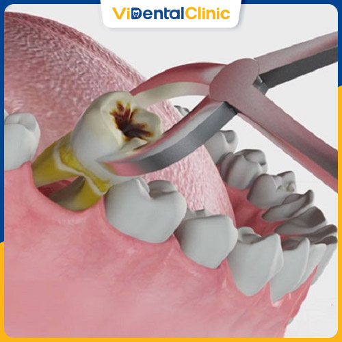 Nhổ răng cấm bị sâu nặng trong trường hợp không thể bảo tồn
