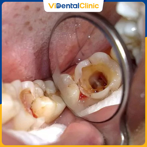 Răng hàm bị sâu nặng làm xuất hiện lỗ hổng trên răng