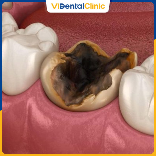 Nếu không xử lý, cấu trúc răng bị phá hủy, dễ mất răng vĩnh viễn