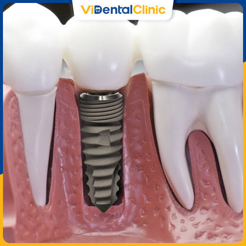 Răng hàm bị sâu nặng có thể phải nhổ và trồng răng Implant