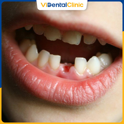 Nếu răng sữa của trẻ mất quá sớm có thể khiến răng vĩnh viễn mọc lệch