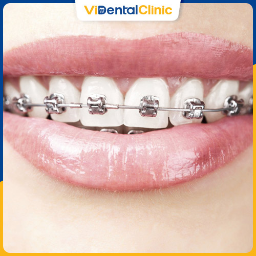 Niềng răng là phương pháp hiệu quả để khắc phục răng mọc lệch