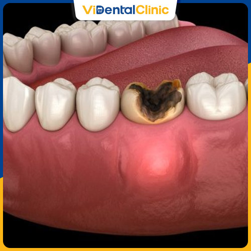 Răng số 6 có thể bị sâu nặng do nhiều nguyên nhân