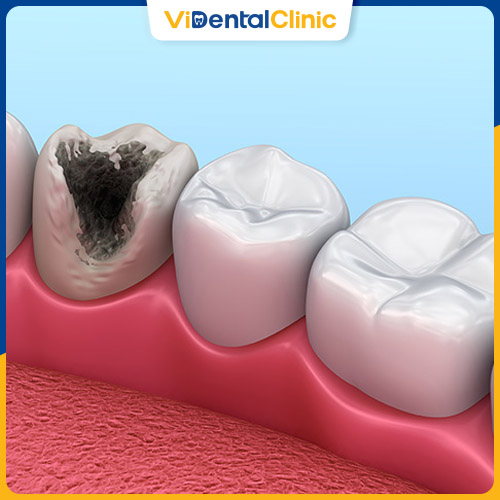 Khi răng sâu nặng, bề mặt răng bị nứt vỡ, có lỗ màu đen