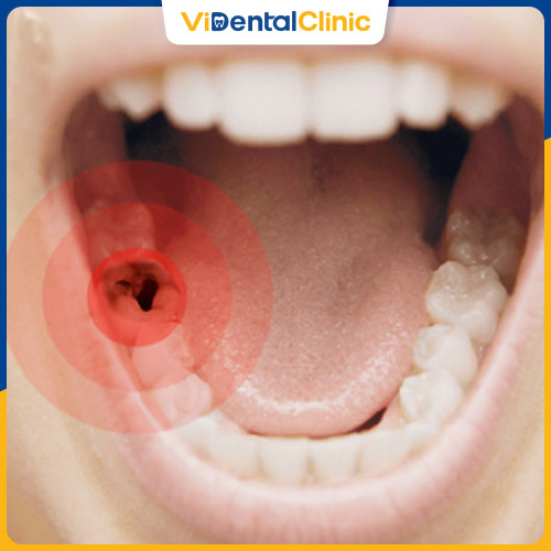 Răng sâu khiến người bệnh mất khả năng ăn nhai